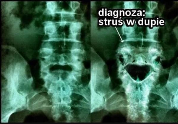 Diagnoza: Struś w dupie